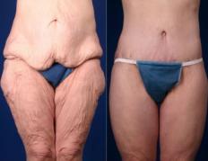 Pyo_Body_Contouring_After_Massive_Weight_Loss25914-82348FINAL.jpg