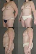 abdominoplasty-with-liposuction-g2_s46UQca.jpg