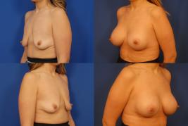 bilateral-breast-augmentation-with-silicone-G1.jpg