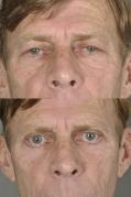 blepharoplasty-p2.jpg