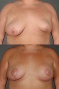breast-asymmetry-augmentation-and-lift-p7.jpg