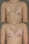 breast-asymmetry-augmentation-and-revision-p1.jpg