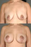 breast-augmentation-and-lift-p7.jpg