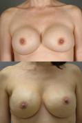 breast-augmentation-and-revision-p1.jpg