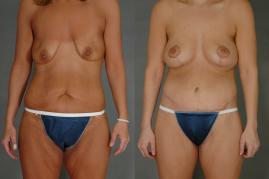 breast-augmentation-and-tummy-tuck-p1.jpg