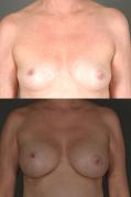 breast-augmentation-p10.jpg