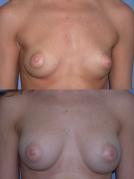 breast-augmentation-p11.jpg