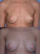 breast-augmentation-p11.jpg