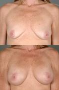 breast-augmentation-p12.jpg