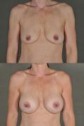 breast-augmentation-p13.jpg
