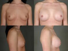 breast-augmentation-p15.jpg