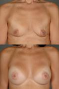 breast-augmentation-p16.jpg