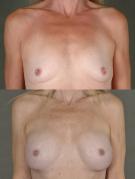 breast-augmentation-p17.jpg