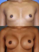 breast-augmentation-p18.jpg
