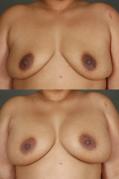 breast-augmentation-p19.jpg