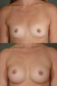 breast-augmentation-p22.jpg