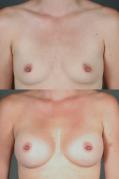 breast-augmentation-p23.jpg