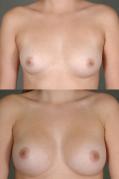 breast-augmentation-p24.jpg