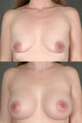 breast-augmentation-p25.jpg