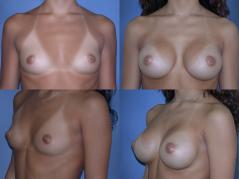 breast-augmentation-p27.jpg