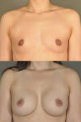breast-augmentation-p28.jpg
