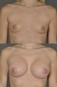 breast-augmentation-p3.jpg