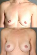 breast-augmentation-p34.jpg