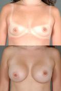 breast-augmentation-p35.jpg
