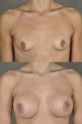 breast-augmentation-p4.jpg