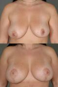 breast-augmentation-p5.jpg