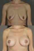 breast-augmentation-p6.jpg