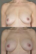 breast-augmentation-p7.jpg