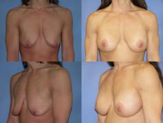 breast-augmentation-p8.jpg