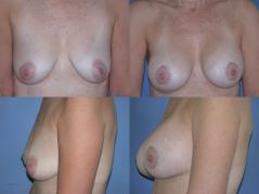 breast-lift-and-augmentation-p4.jpg