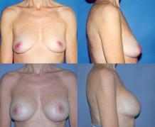 breast-lift-and-augmentation-p5.jpg