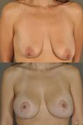 breast-lift-and-augmentation-p6.jpg