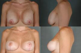 breast-lift-and-implant-revision-p1.jpg