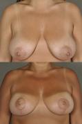 breast-lift-p2.jpg