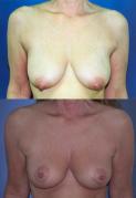 breast-lift-p3.jpg