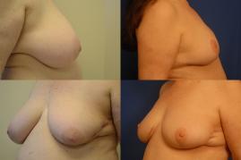 breast-reconstruction-and-scar-revision-g3.jpg