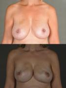 breast-reconstruction-and-tissue-expanders-p10.jpg