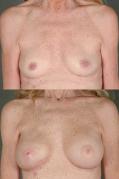 breast-reconstruction-and-tissue-expanders-p12.jpg