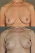 breast-reconstruction-and-tissue-expanders-p13.jpg