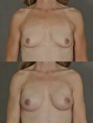 breast-reconstruction-and-tissue-expanders-p14.jpg