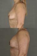 breast-reconstruction-and-tissue-expanders-p16.jpg