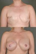 breast-reconstruction-and-tissue-expanders-p17.jpg