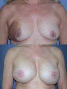 breast-reconstruction-and-tissue-expanders-p18.jpg