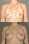 breast-reconstruction-and-tissue-expanders-p19.jpg