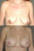 breast-reconstruction-and-tissue-expanders-p1_crPBE9o.jpg