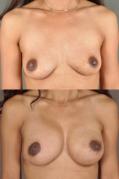 breast-reconstruction-and-tissue-expanders-p2.jpg